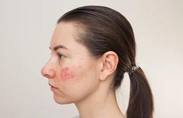 Best Dermatologist in Lucknow