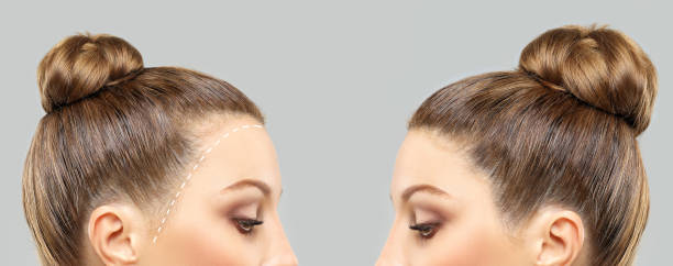 Hair Transplant Cost in Saudi Arabia 2026